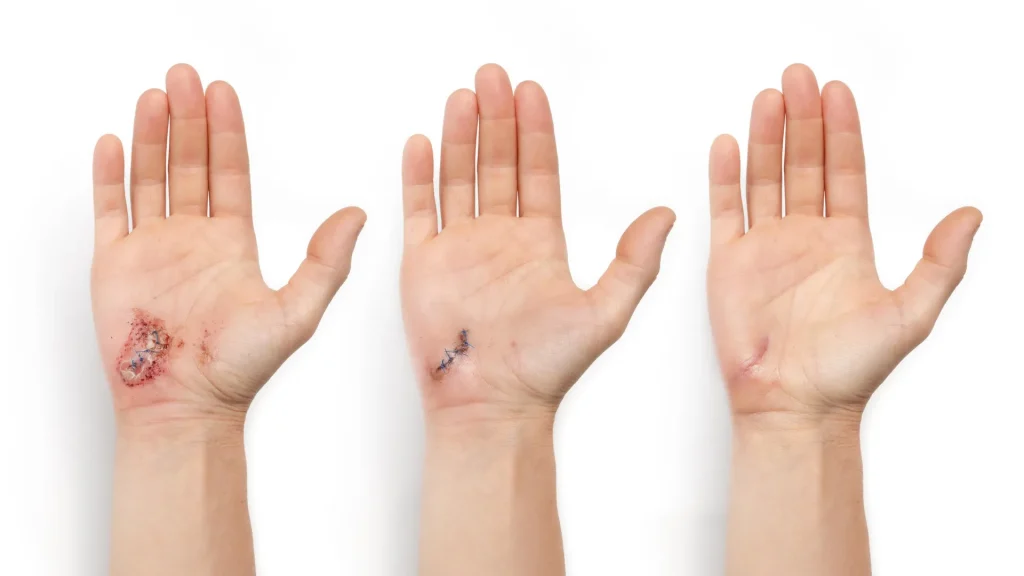 AI-powered smart bandage heals wounds 25% faster