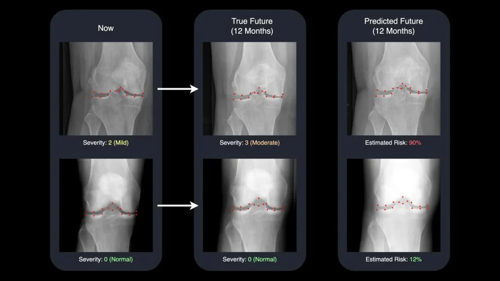 AI turns x-rays into time machines for arthritis care